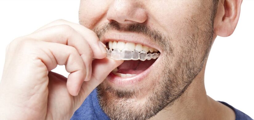 man showing invisalign braces in his mouth