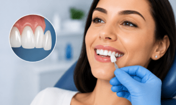 Veneers